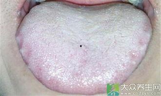 舌苔发黄图片,揭秘健康信号与调理方法